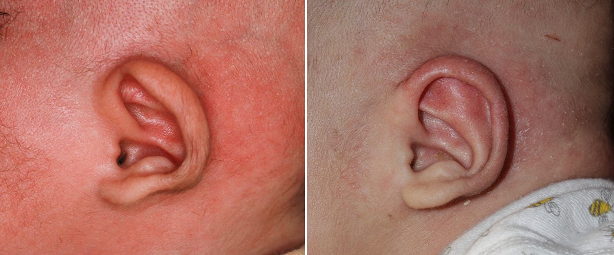 Earwell (Microtia) Before & After Gallery - Patient 429251 - Image 2
