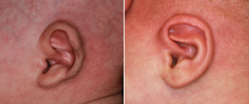 Earwell (Microtia) Before & After Gallery - Patient 163059 - Image 1