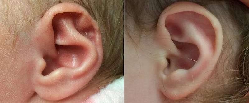 Earwell (Microtia) Before & After Gallery - Patient 260338 - Image 1