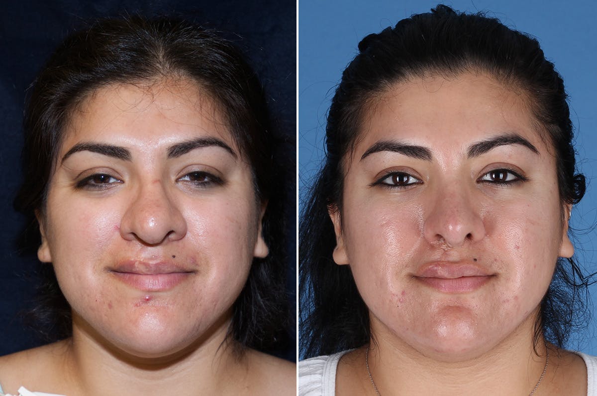 Cleft Lip Rhinoplasty Before & After Gallery - Patient 887248 - Image 2