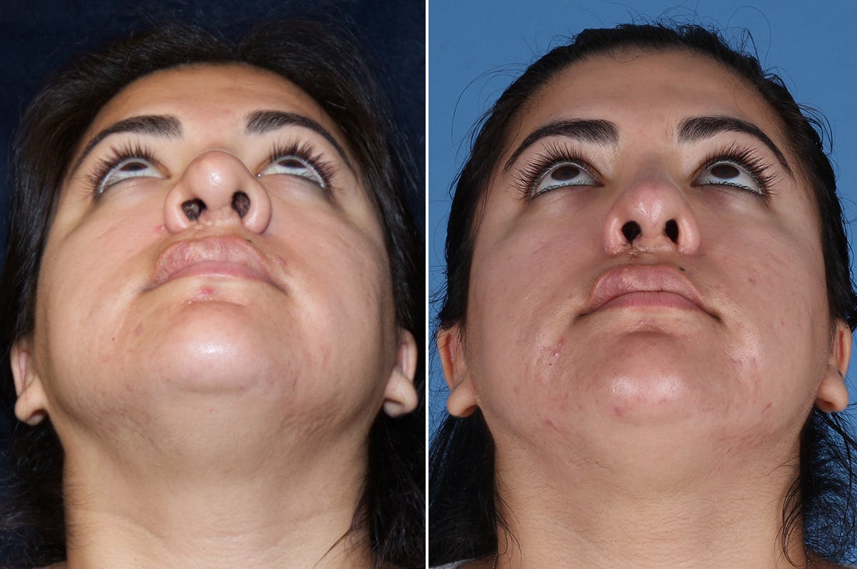 Cleft Lip Rhinoplasty Before & After Gallery - Patient 887248 - Image 3