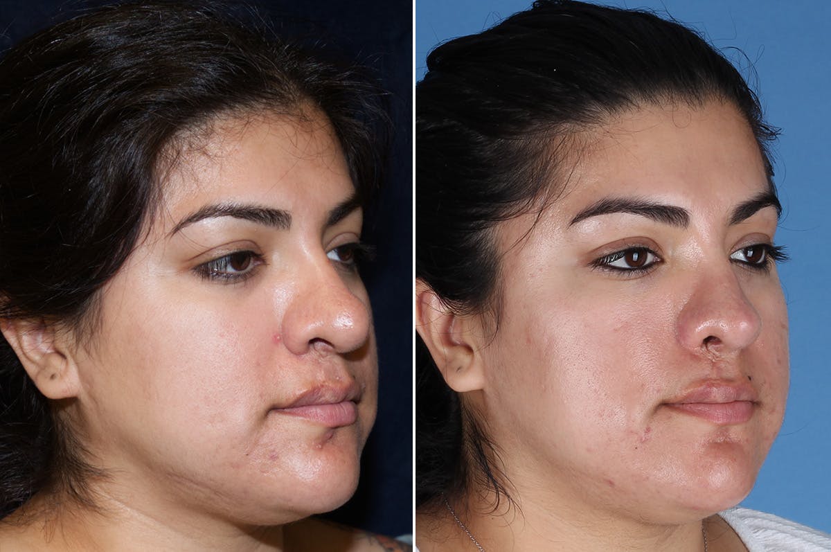 Cleft Lip Rhinoplasty Before & After Gallery - Patient 887248 - Image 4