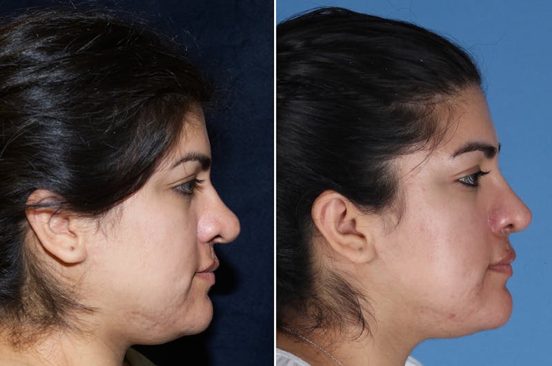 Cleft Lip Rhinoplasty Before & After Gallery - Patient 887248 - Image 1