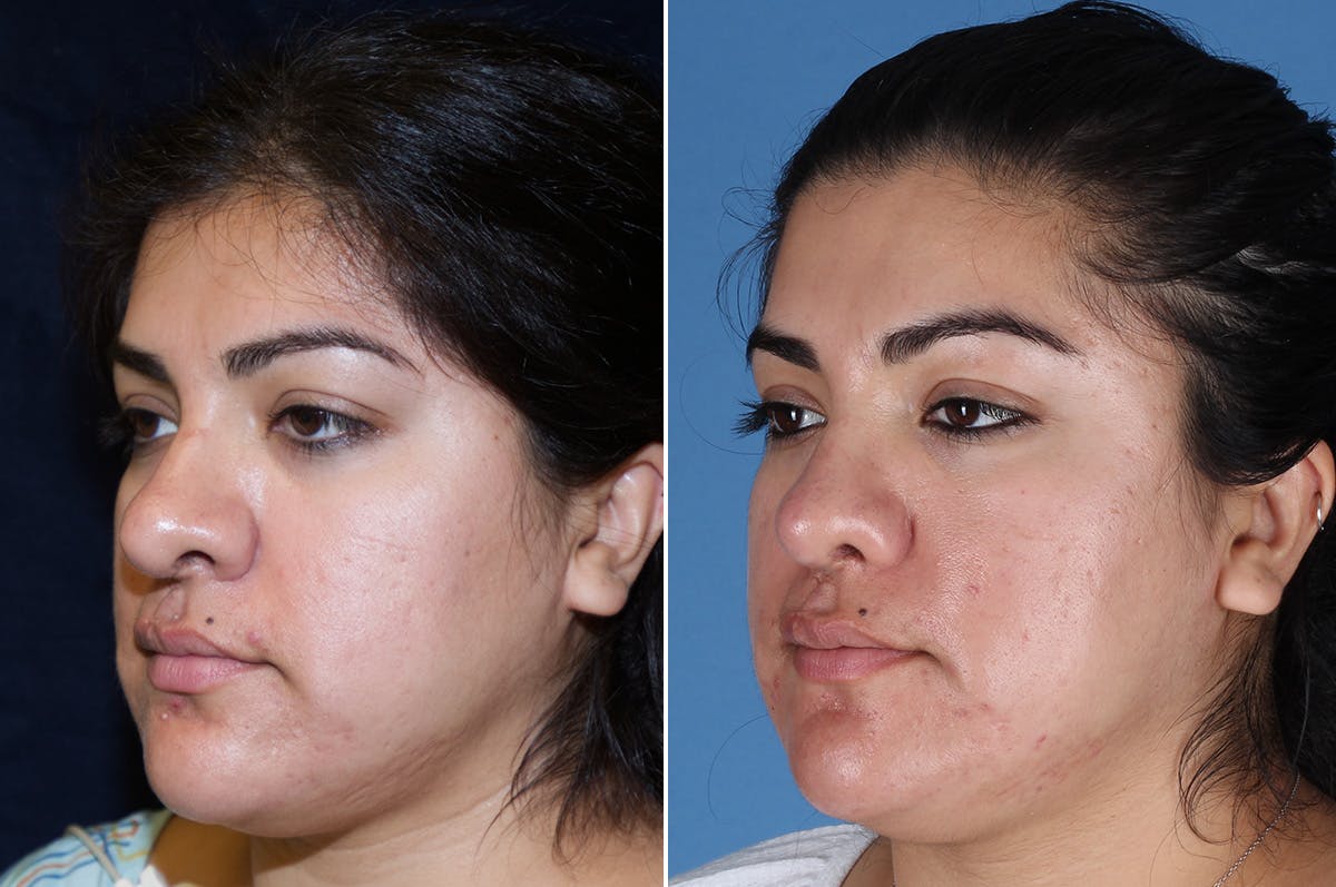 Cleft Lip Rhinoplasty Before & After Gallery - Patient 887248 - Image 5
