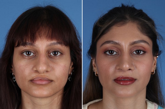 Cleft rhinoplasty before and after — actual patient of Andre Panossian, MD