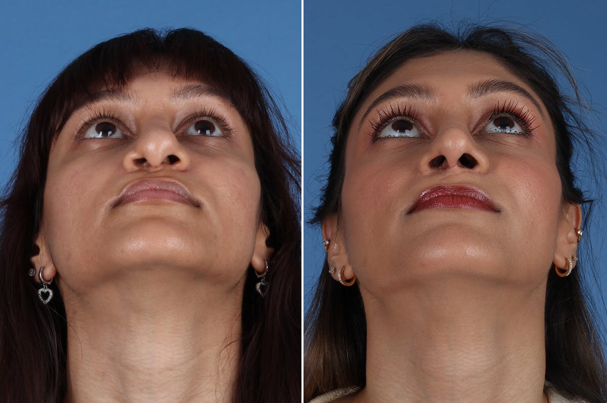 Cleft Lip Rhinoplasty Before & After Gallery - Patient 218306 - Image 3