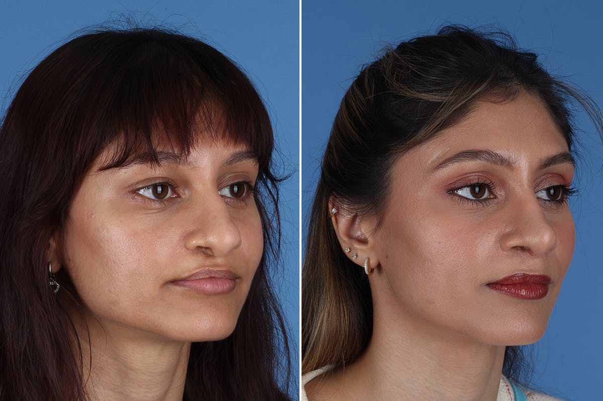 Cleft Lip Rhinoplasty Before & After Gallery - Patient 218306 - Image 4
