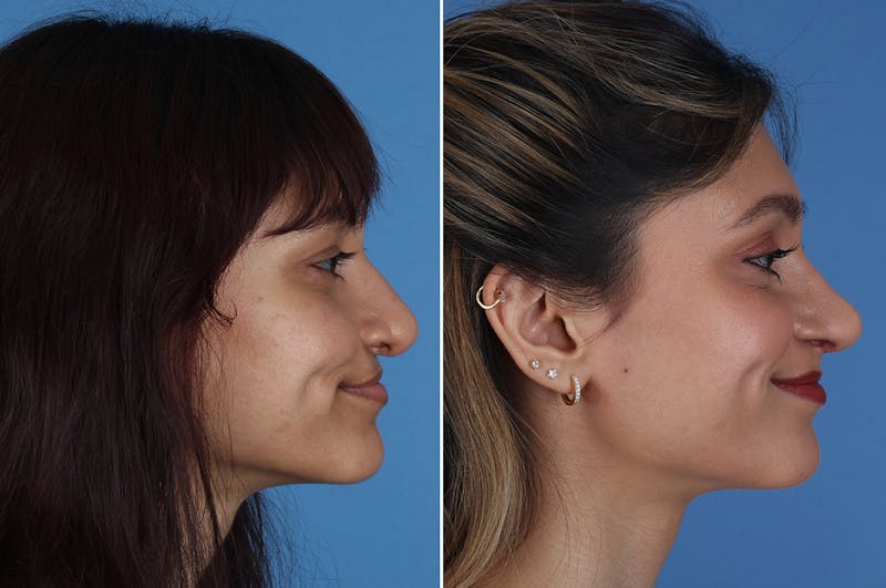 Cleft Lip Rhinoplasty Before & After Gallery - Patient 218306 - Image 1
