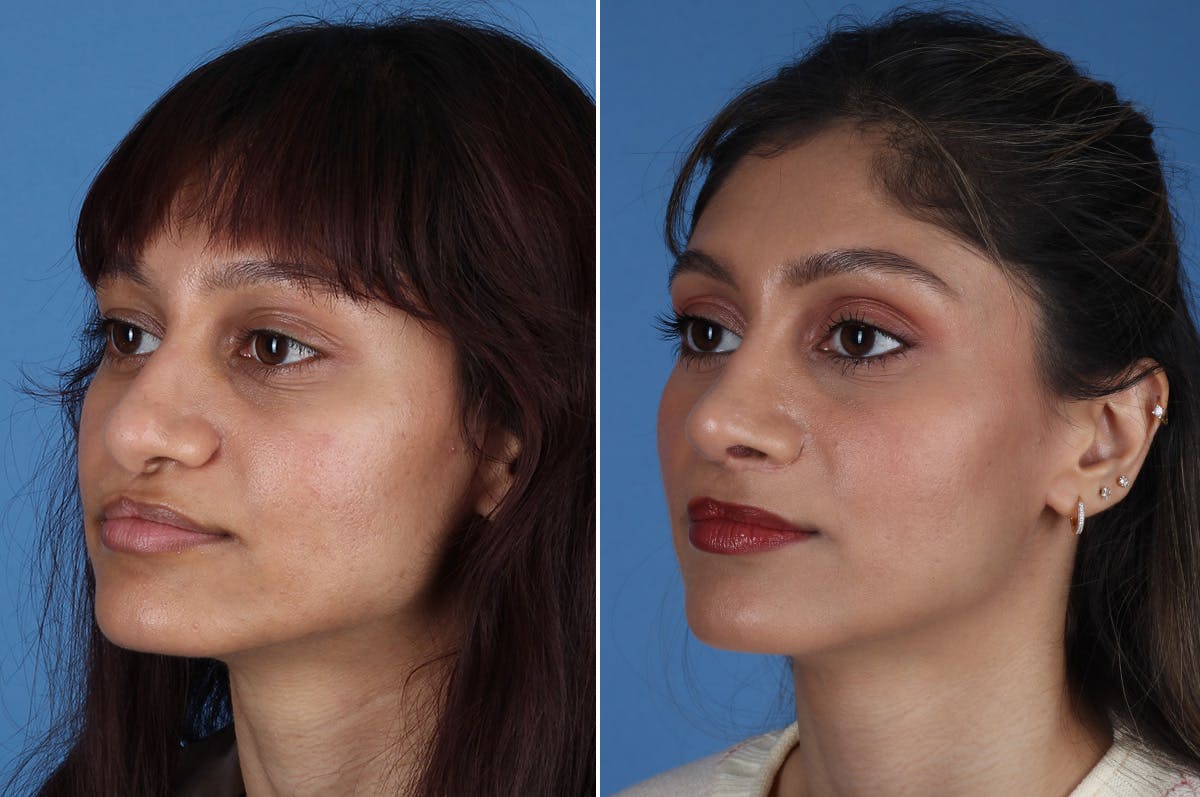Cleft Lip Rhinoplasty Before & After Gallery - Patient 218306 - Image 5