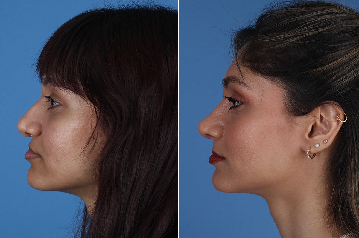 Cleft Lip Rhinoplasty Before & After Gallery - Patient 218306 - Image 6