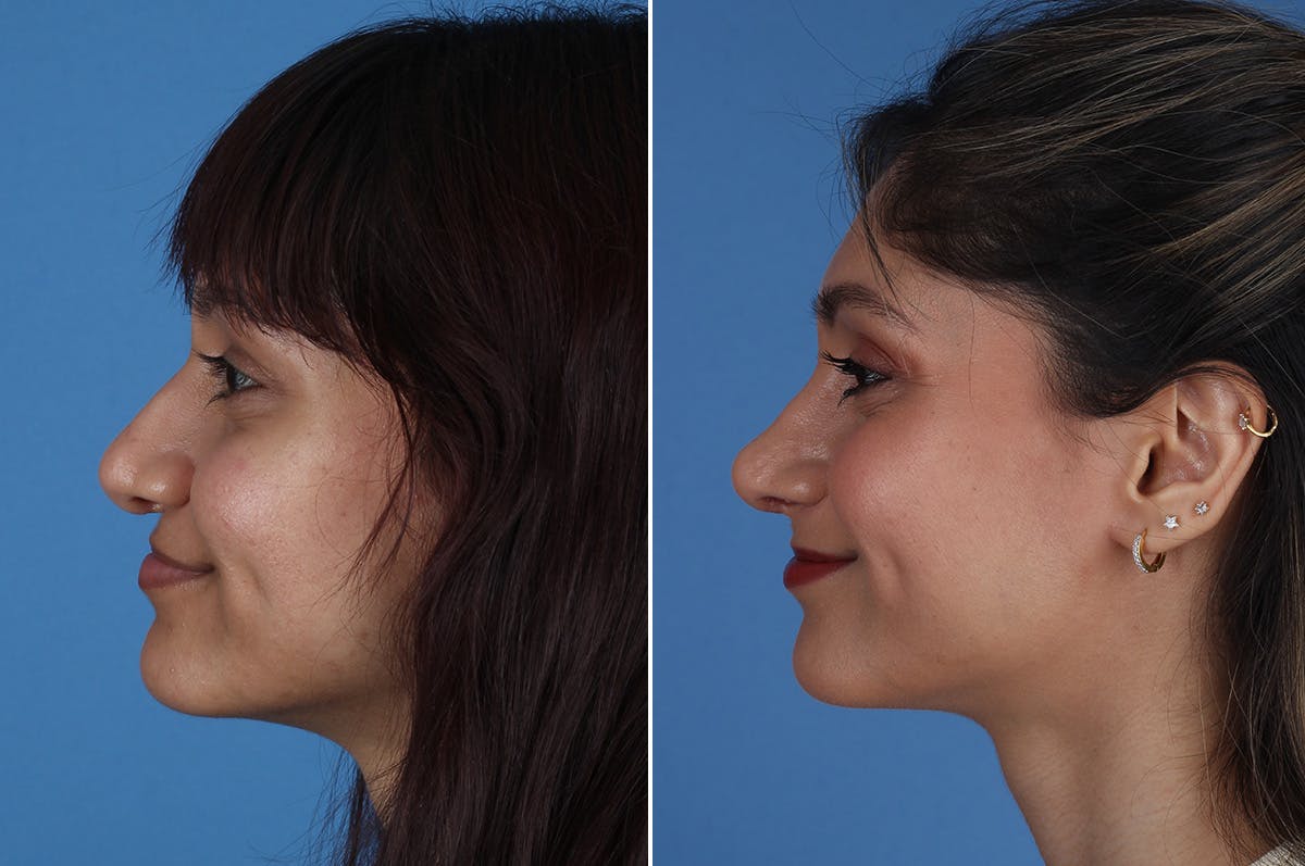 Cleft Lip Rhinoplasty Before & After Gallery - Patient 218306 - Image 7