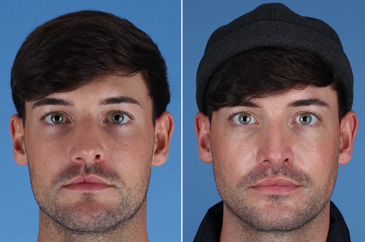 Cleft Lip Rhinoplasty Before & After Gallery - Patient 395716 - Image 2