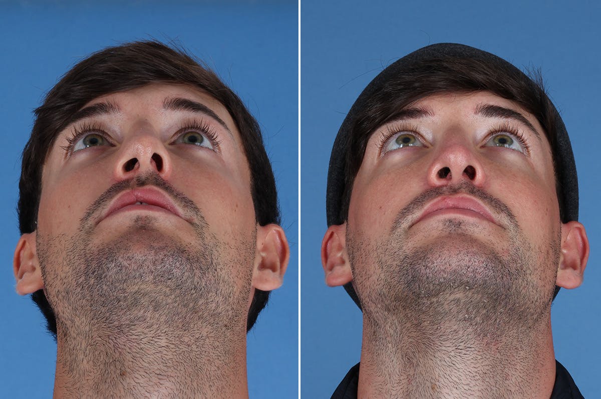Cleft Lip Rhinoplasty Before & After Gallery - Patient 395716 - Image 3
