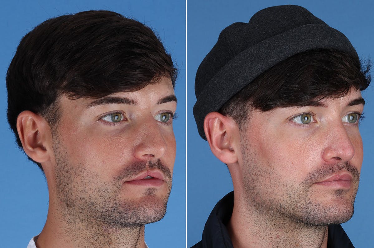 Cleft Lip Rhinoplasty Before & After Gallery - Patient 395716 - Image 4