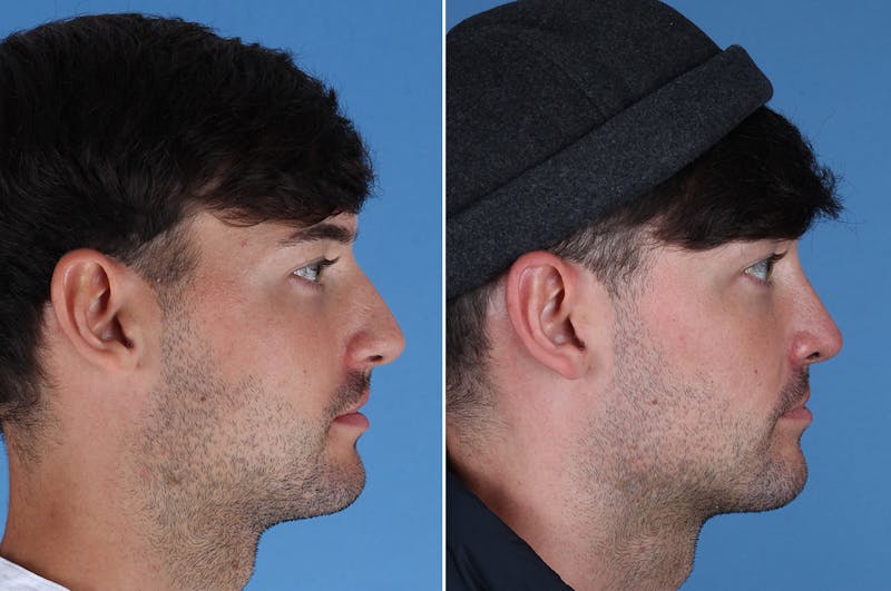 Cleft Lip Rhinoplasty Before & After Gallery - Patient 395716 - Image 1