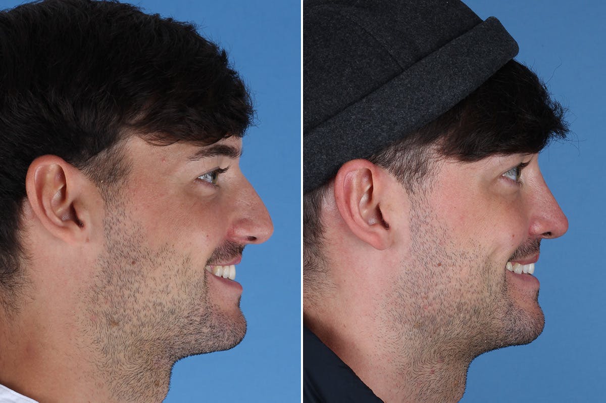 Cleft Lip Rhinoplasty Before & After Gallery - Patient 395716 - Image 5