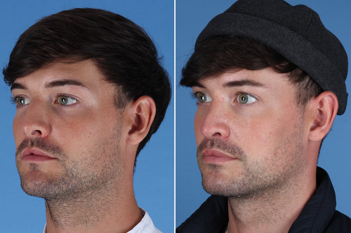Cleft Lip Rhinoplasty Before & After Gallery - Patient 395716 - Image 6