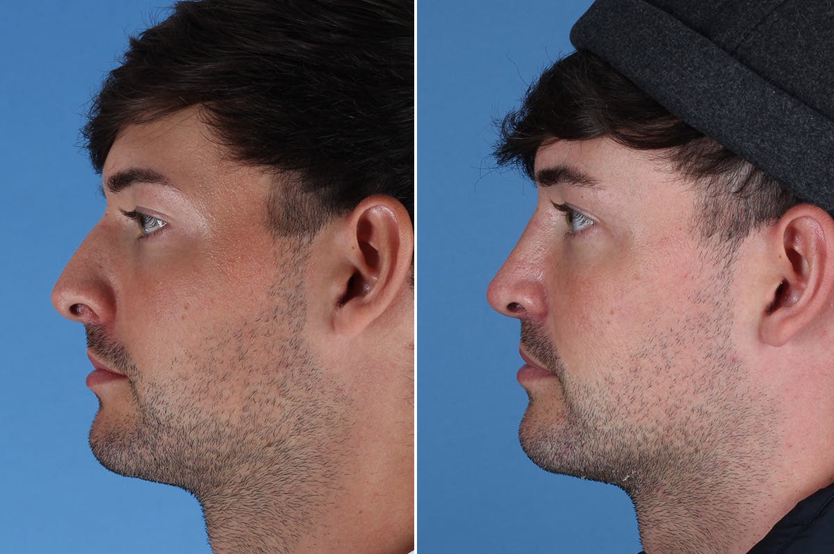 Cleft Lip Rhinoplasty Before & After Gallery - Patient 395716 - Image 7