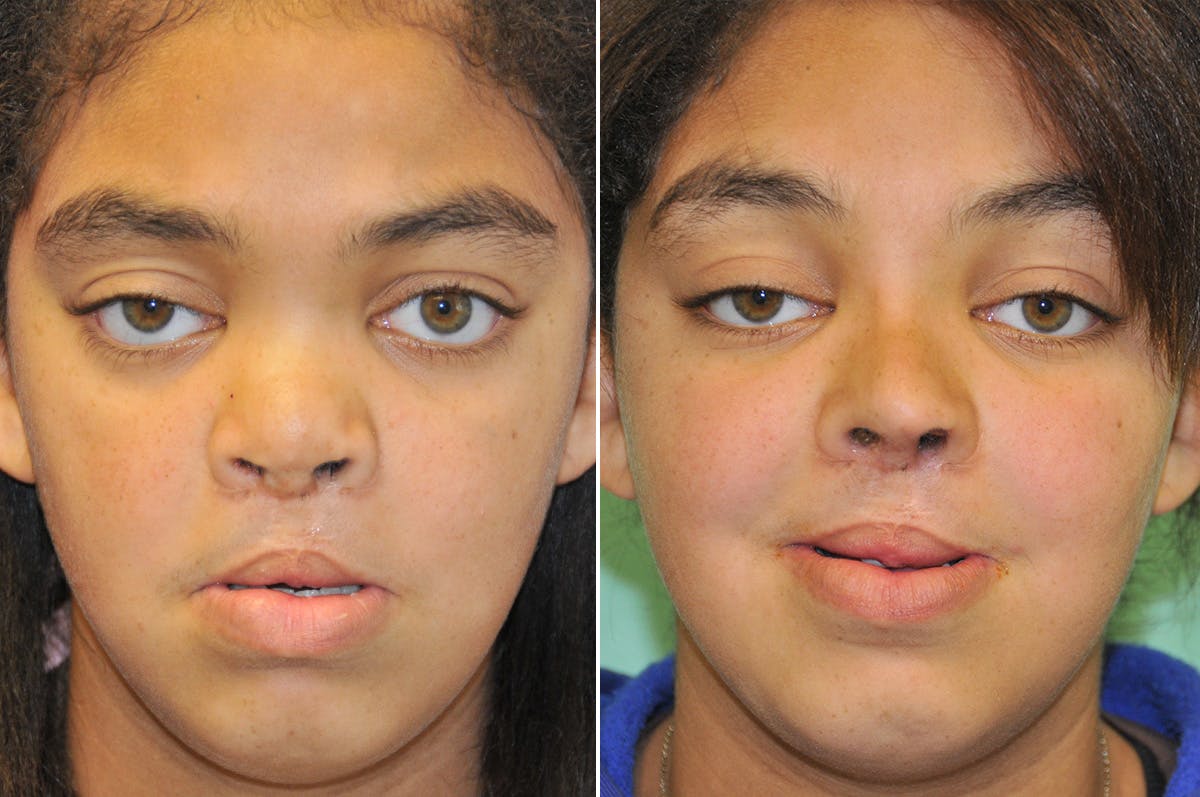 Cleft Lip Rhinoplasty Before & After Gallery - Patient 288821 - Image 2