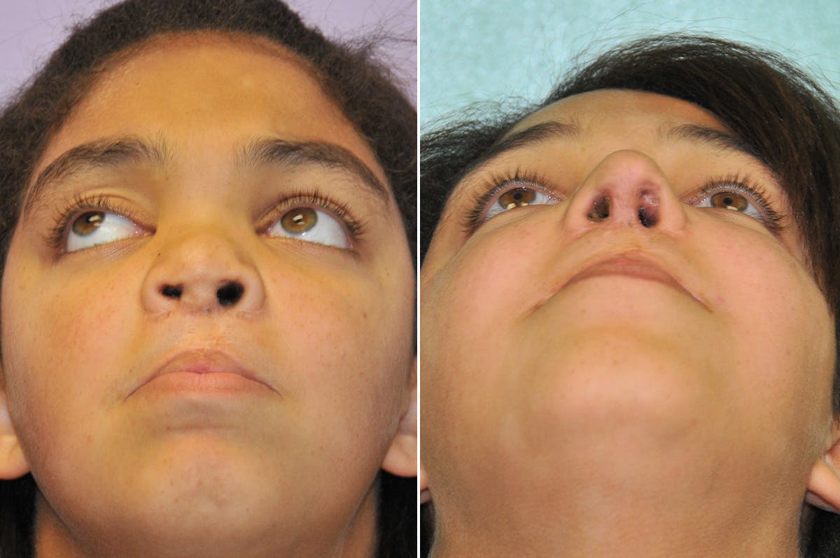 Cleft Lip Rhinoplasty Before & After Gallery - Patient 288821 - Image 3