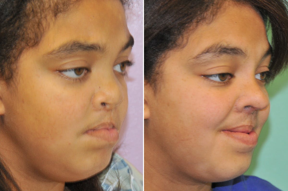 Cleft Lip Rhinoplasty Before & After Gallery - Patient 288821 - Image 4
