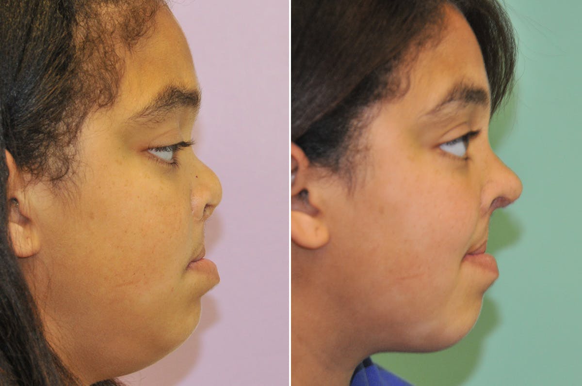 Cleft Lip Rhinoplasty Before & After Gallery - Patient 288821 - Image 1