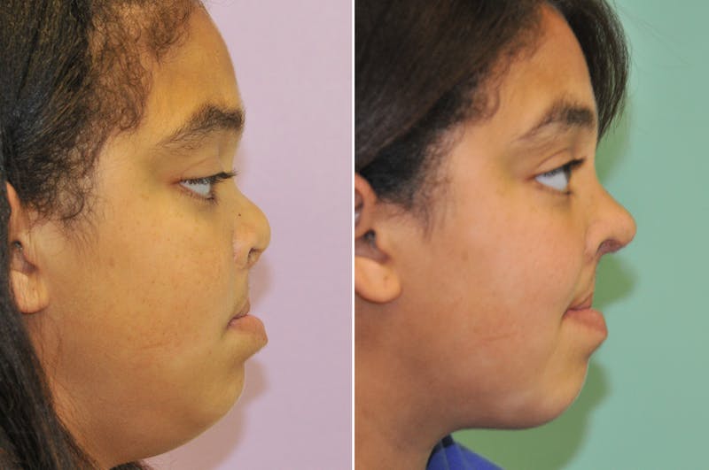 Cleft Lip Rhinoplasty Before & After Gallery - Patient 288821 - Image 1