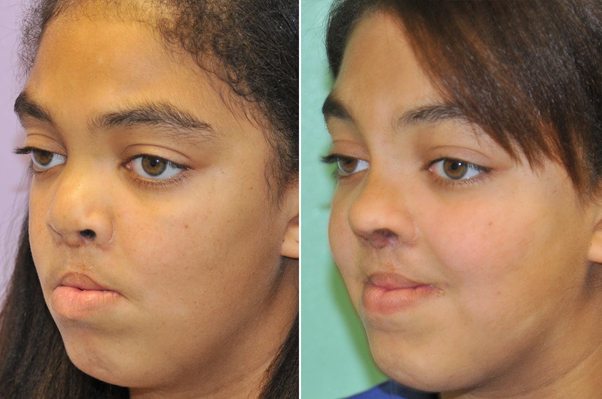 Cleft Lip Rhinoplasty Before & After Gallery - Patient 288821 - Image 5