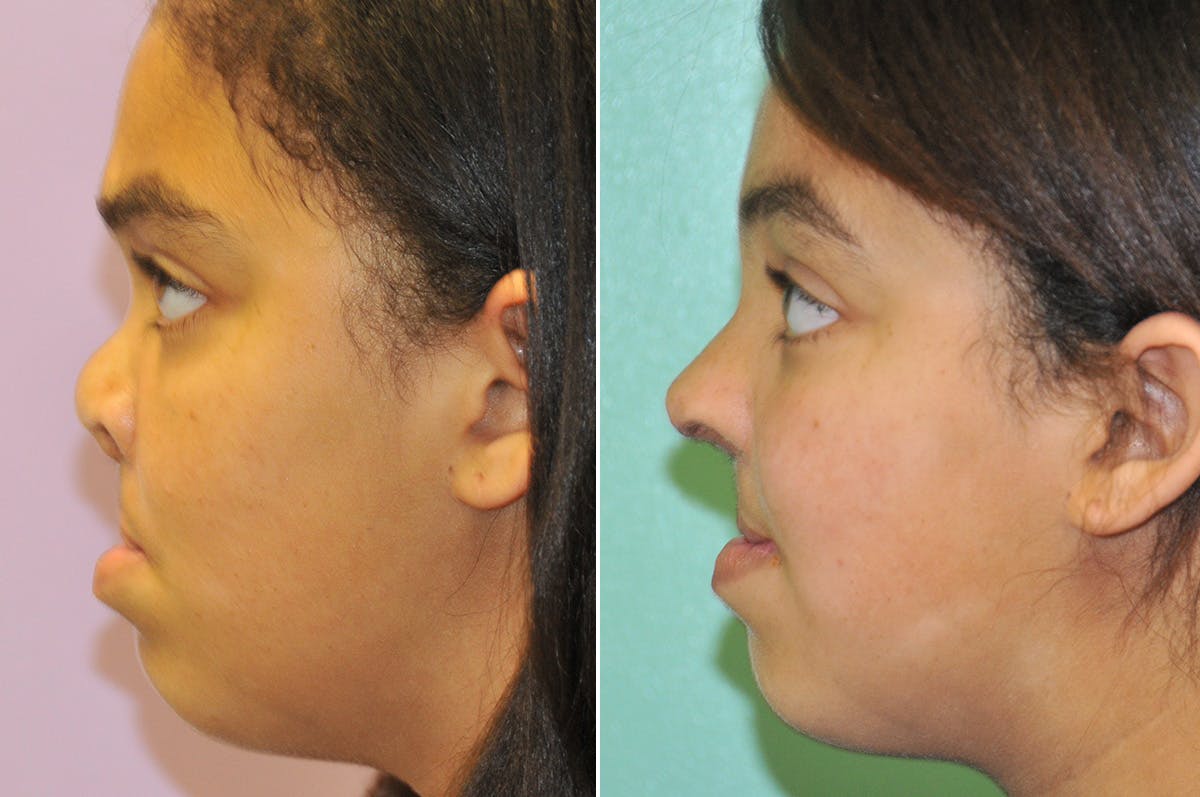Cleft Lip Rhinoplasty Before & After Gallery - Patient 288821 - Image 6