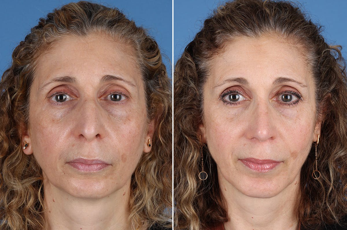 Chin Implants Before & After Gallery - Patient 195780 - Image 1