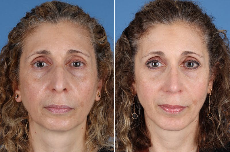 Chin Implants Before & After Gallery - Patient 195780 - Image 1