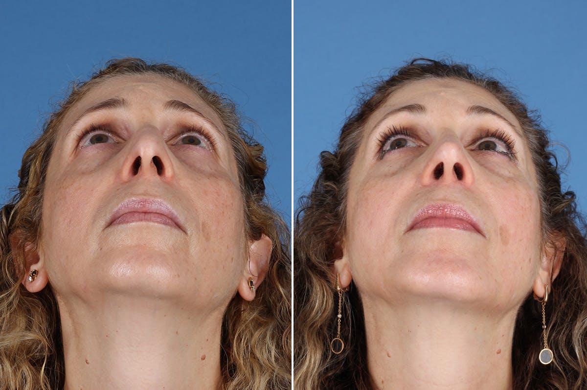 Chin Implants Before & After Gallery - Patient 195780 - Image 2