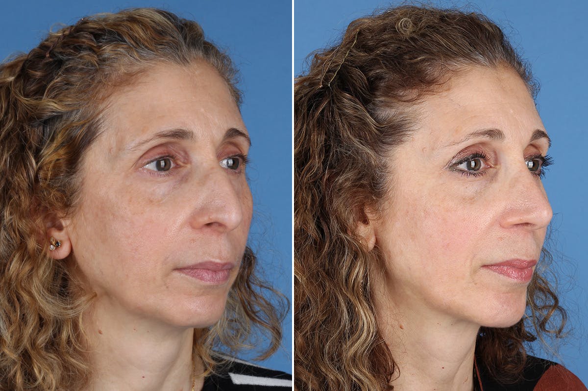 Chin Implants Before & After Gallery - Patient 195780 - Image 3