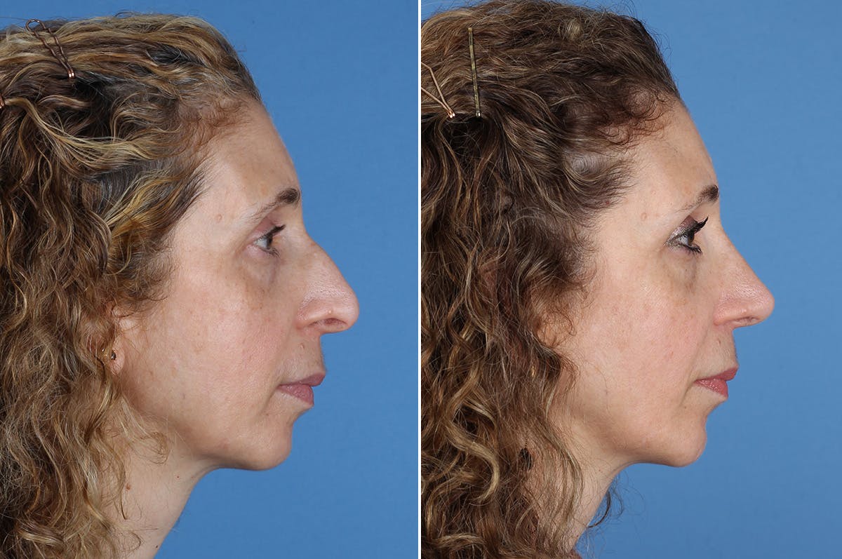 Chin Implants Before & After Gallery - Patient 195780 - Image 4