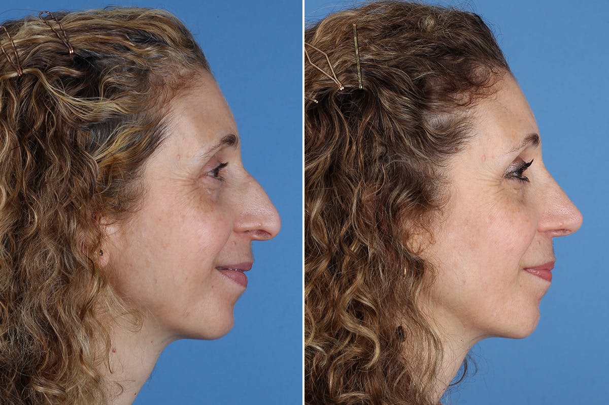 Chin Implants Before & After Gallery - Patient 195780 - Image 5