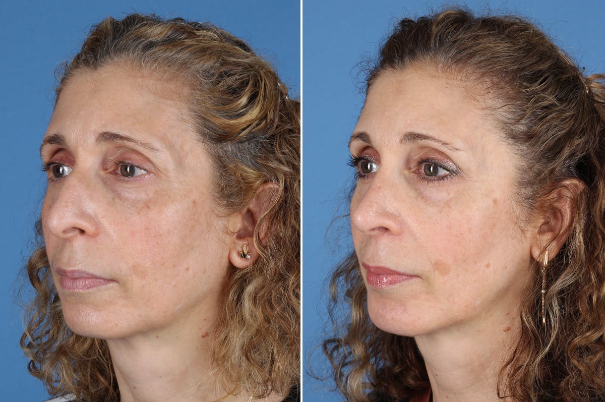 Chin Implants Before & After Gallery - Patient 195780 - Image 6