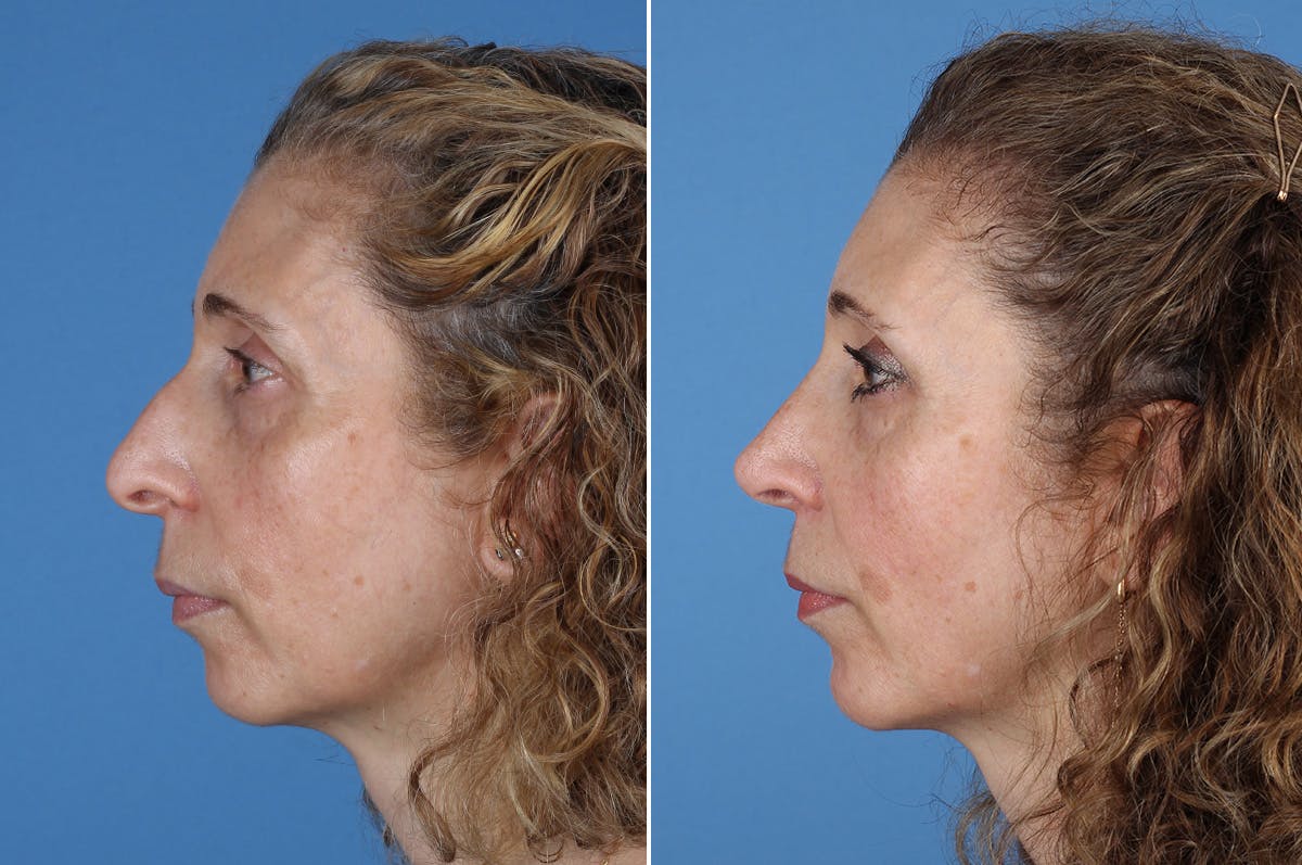 Chin Implants Before & After Gallery - Patient 195780 - Image 7