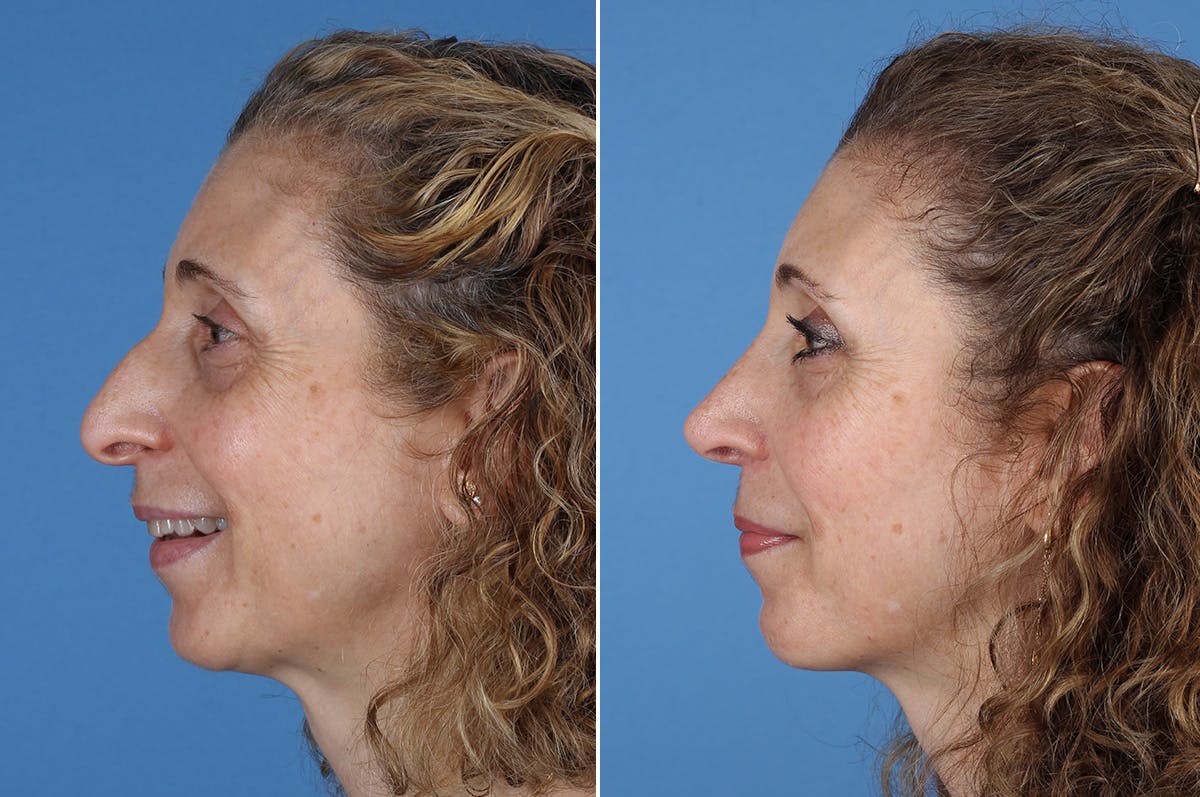 Chin Implants Before & After Gallery - Patient 195780 - Image 8