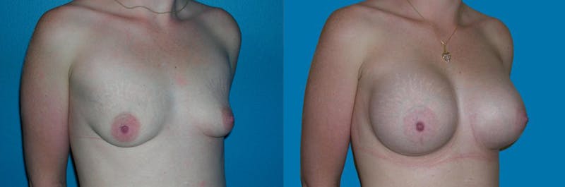 Breast Augmentation Before & After Gallery - Patient 190716 - Image 1