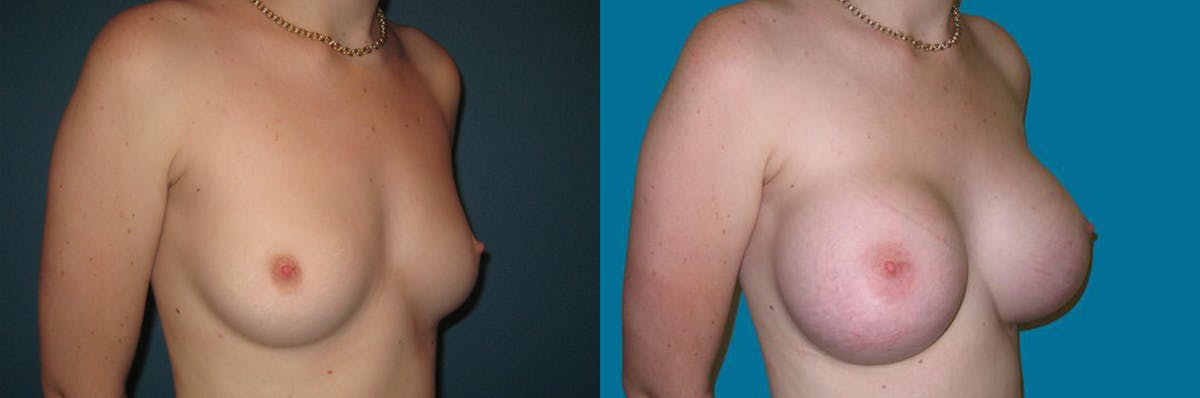 Breast Augmentation Before & After Gallery - Patient 331867 - Image 1