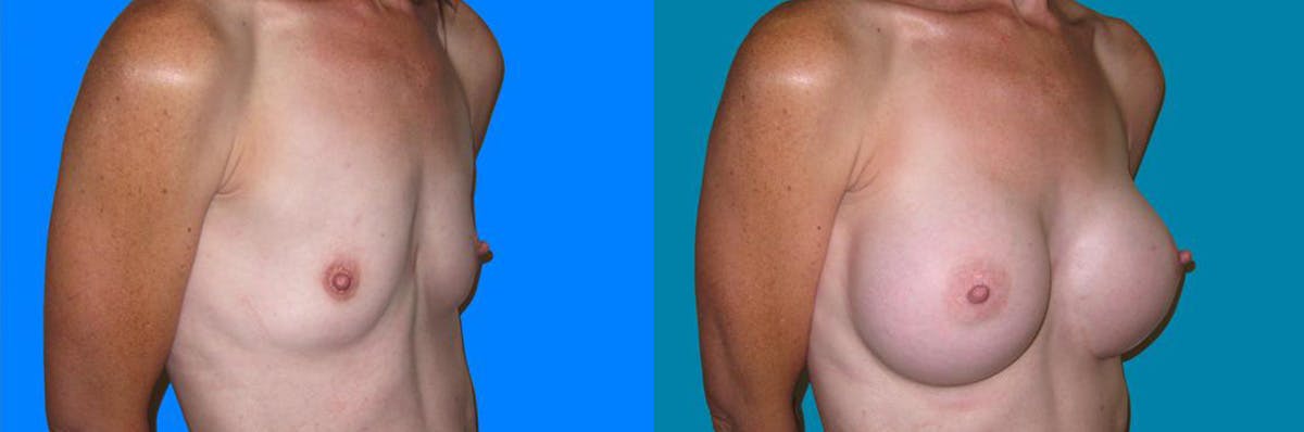 Breast Augmentation Before & After Gallery - Patient 141747 - Image 1
