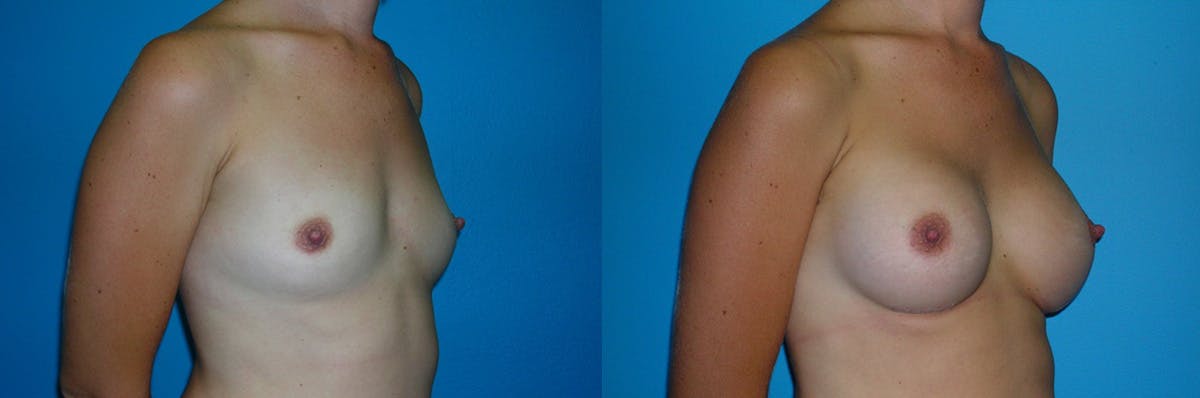 Breast Augmentation Before & After Gallery - Patient 411373 - Image 1