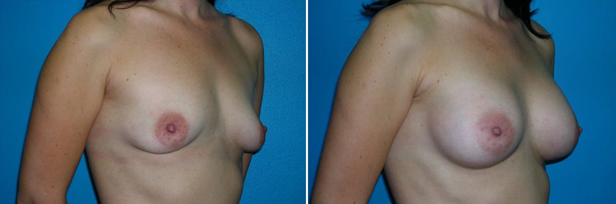 Breast Augmentation Before & After Gallery - Patient 419456 - Image 1