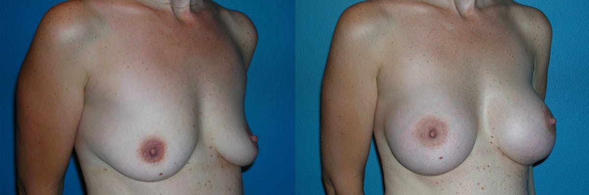 Breast Augmentation Before & After Gallery - Patient 399487 - Image 1