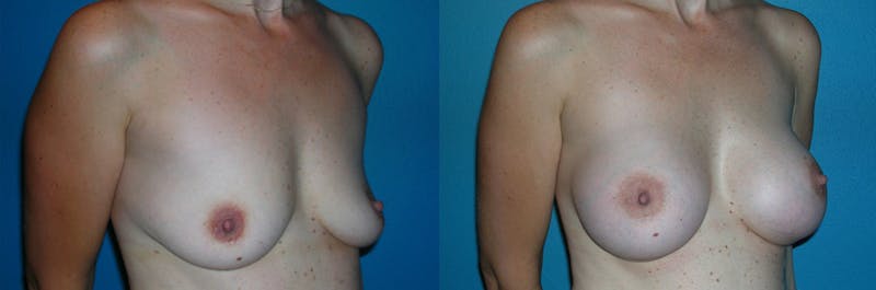 Breast Augmentation Before & After Gallery - Patient 399487 - Image 1