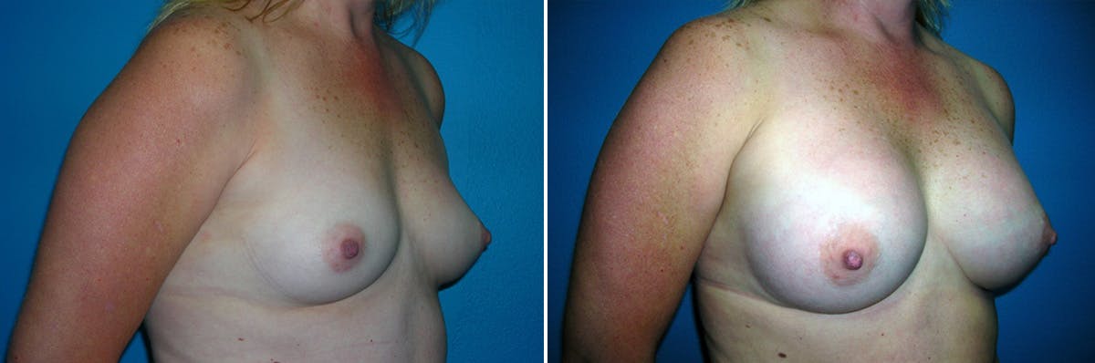 Breast Augmentation Before & After Gallery - Patient 315370 - Image 1