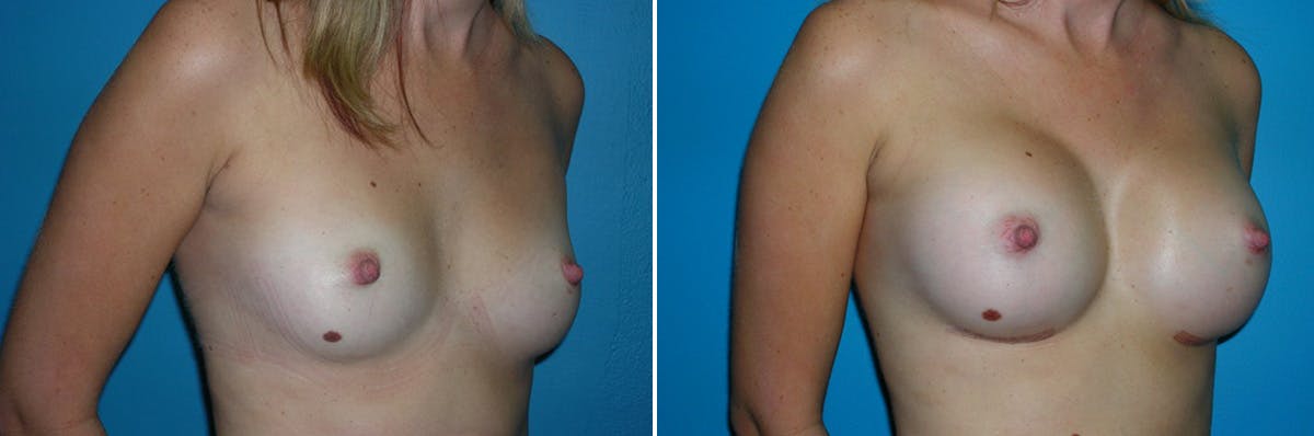 Breast Augmentation Before & After Gallery - Patient 182630 - Image 1