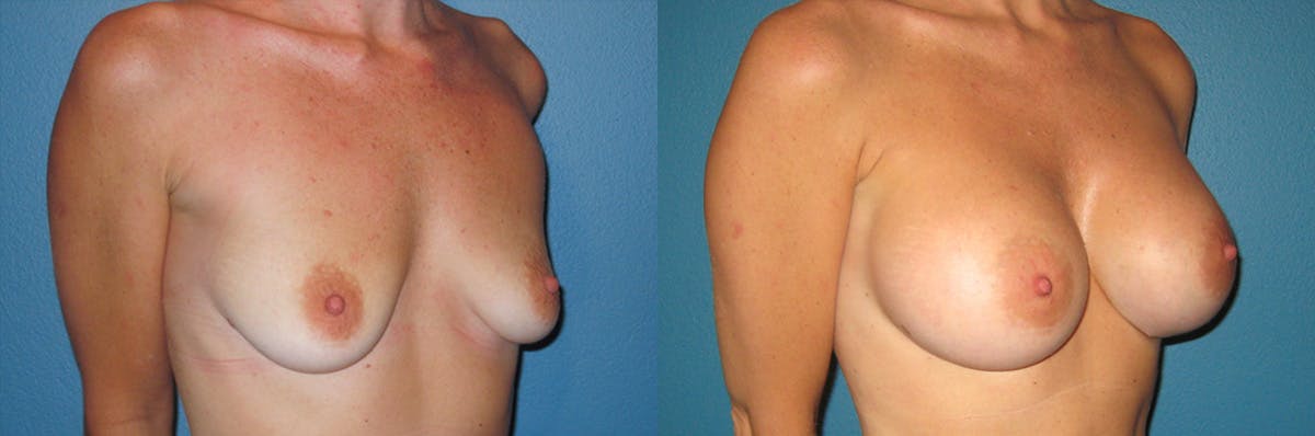 Breast Augmentation Before & After Gallery - Patient 196795 - Image 1