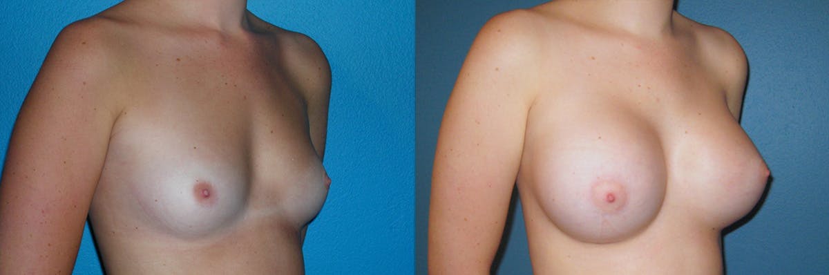 Breast Augmentation Before & After Gallery - Patient 320507 - Image 1