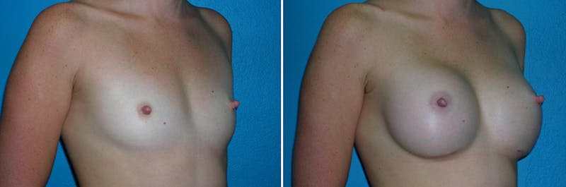 Breast Augmentation Before & After Gallery - Patient 296734 - Image 1